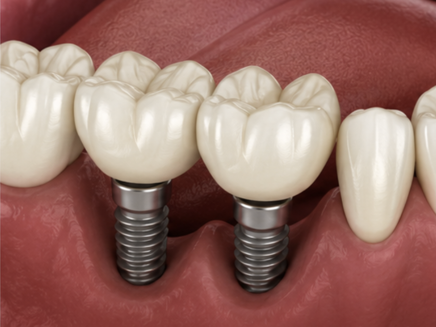 implants multiples