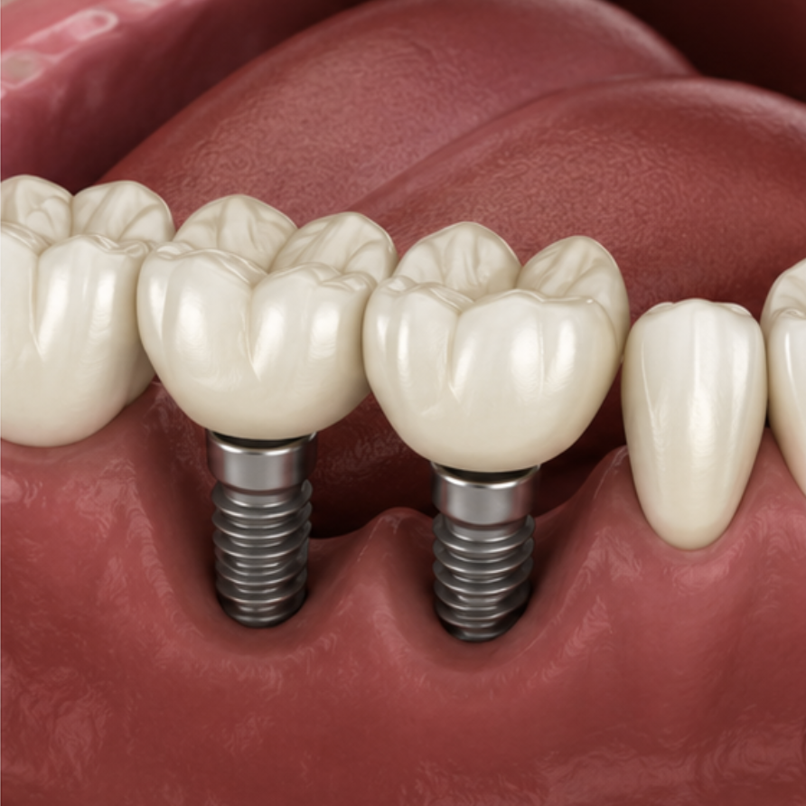 implants multiples